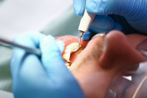 Best Emergency Root Canal Treatment in Hershey, PA
